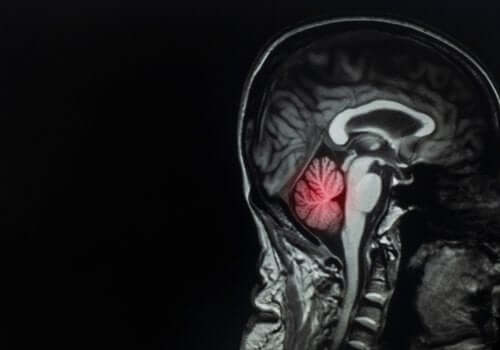 Metastasi cerebrale: definizione, cause e trattamento