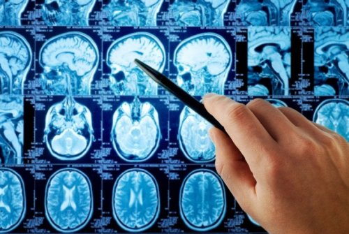 Metastasi cerebrale: esame di risonanza magnetica