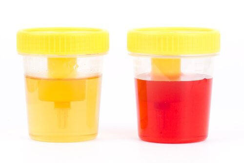 Urine normali e con ematuria