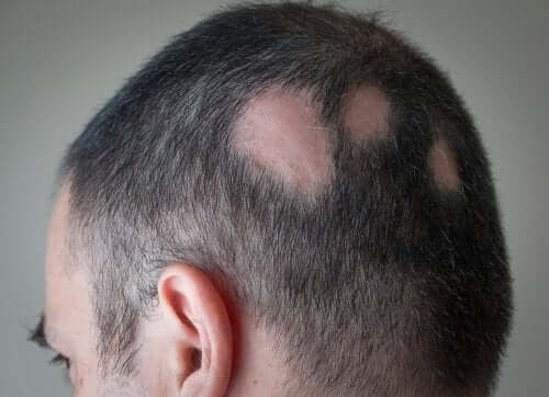 Uomo con alopecia areata