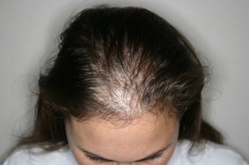 Caduta dei capelli