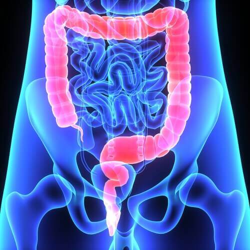 I polipi del colon sono costituiti da porzioni di tessuto aggiuntivo