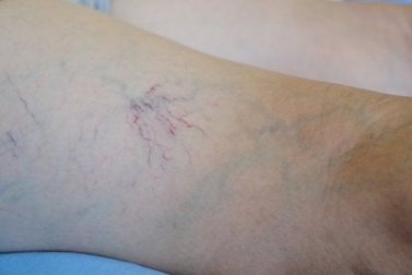 Venoruton: cos'è e a cosa serve?