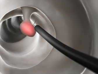 Polipi del colon: cause e trattamento
