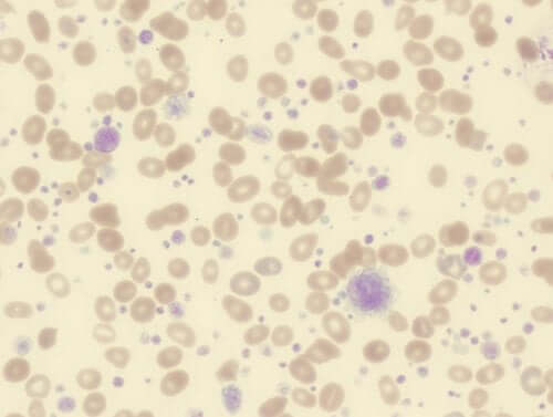 Trombocitosi: sintomi, cause e trattamento