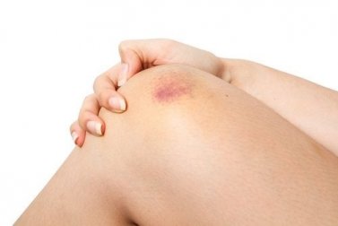 Ecchimosi: cosa sono i lividi e perché si formano?