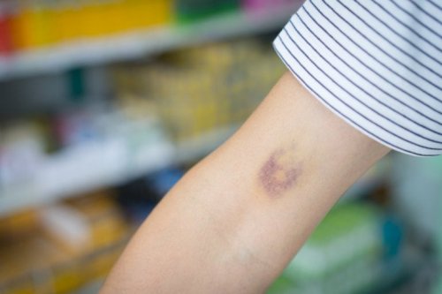 Colore dell'ecchimosi