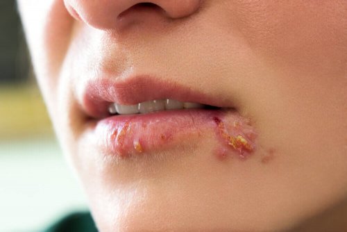 herpes labiale