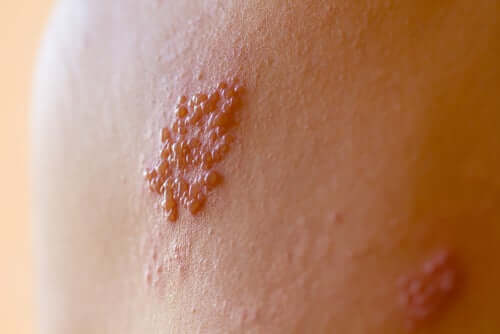 Herpes Zoster