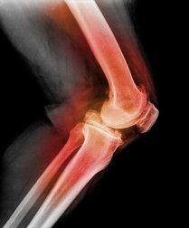 Lussazione della rotula: cause e sintomi