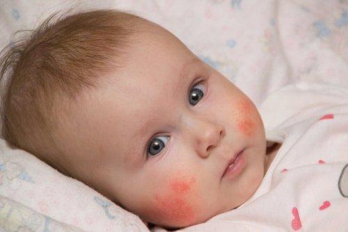 Neonato con dermatite