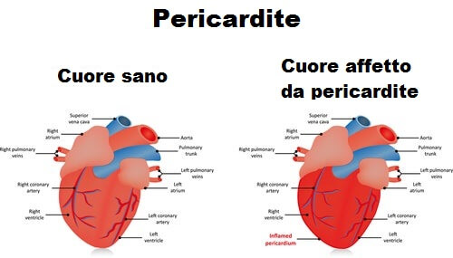 Sintomi e diagnosi della pericardite