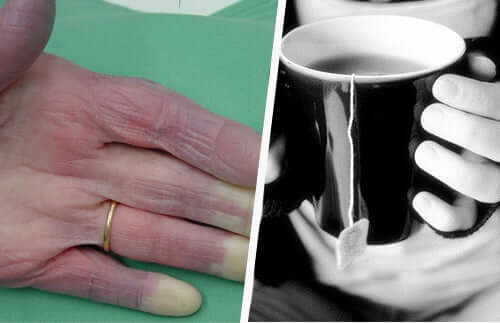 Sindrome de Raynaud e trattamento con nifedipina