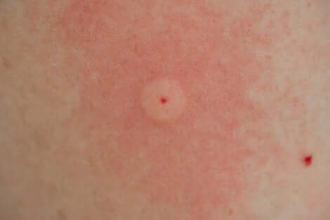 Reazione allergica alle punture di insetti