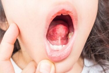 Bollicine sulla lingua: cosa sono e come trattarle?