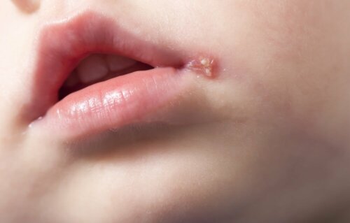 Bambino con herpes labiale o febbre sulle labbra