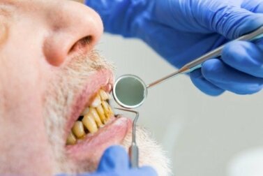 Danni del fumo al cavo orale e come prevenirli