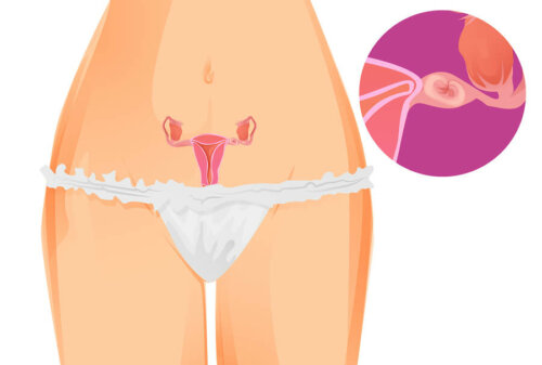 Evoluzione della gravidanza extrauterina