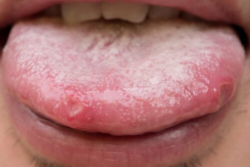 bolle sulla lingua papilloma virus)