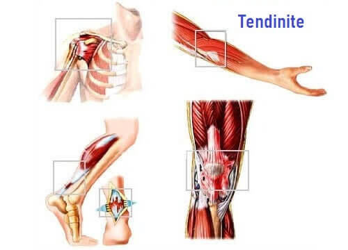 Muscolo con tendinite