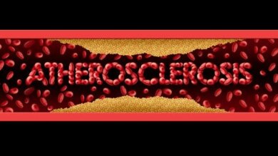 Aterosclerosi: sintomi e trattamento