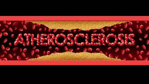 Aterosclerosi: sintomi e trattamento