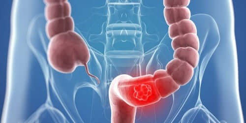 Colostomia trasversa