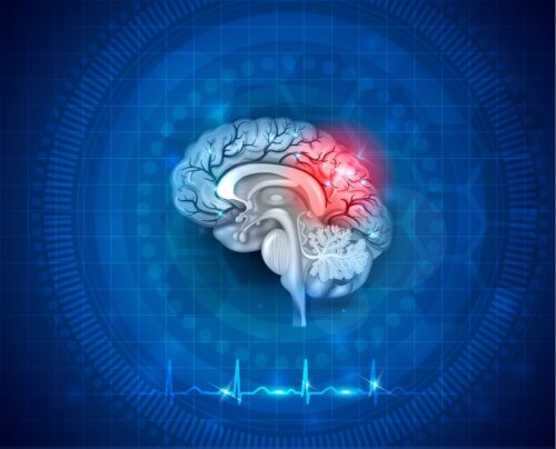 Cervello con evidenziato ictus e neuroplsticità