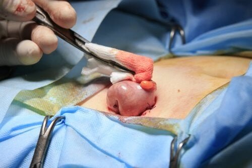 Colostomia: cos'è e quando è necessaria?