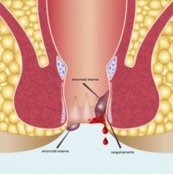 Anoscopia: cos'è e quando è indicata?