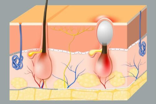 Formazione dei brufoli vaginali
