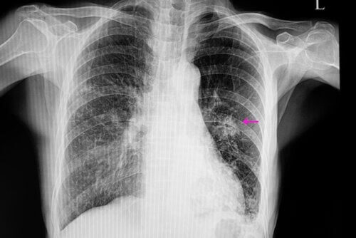 Nodulo polmonare: diagnosi e cura