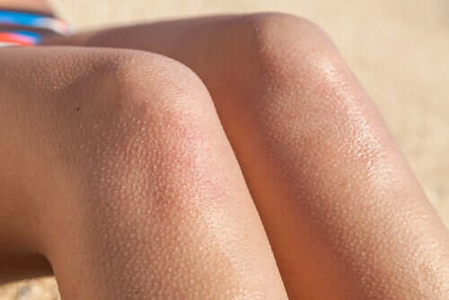 Pelle d'oca sulle gambe