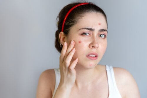 Trattamenti contro l'acne, i farmaci più prescritti