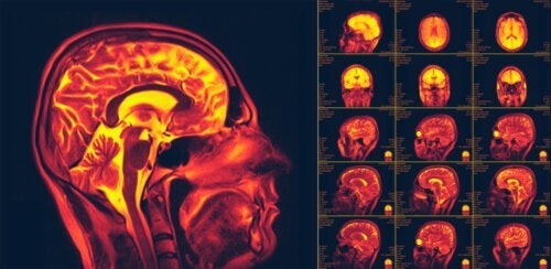 La neuroplasticità: recuperare le funzioni del cervello