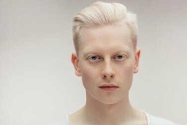 l'albinismo: tutto quello che c'è da sapere