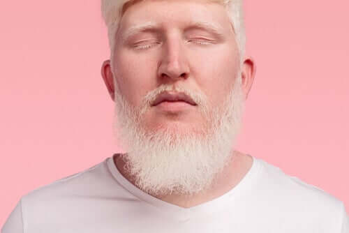 Uomo con lo albinismo in pelle, capelli e occhi.