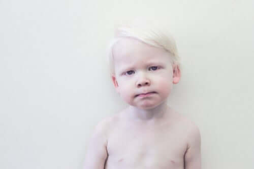 Bambino albino
