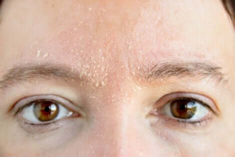 Dermatite sul viso