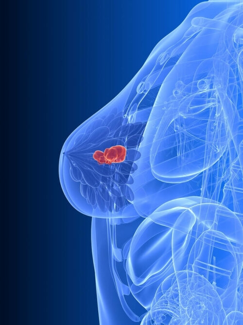 Immagine del corpo femminile e cancro al seno