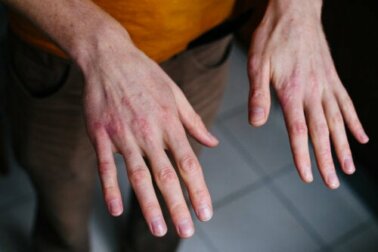 Mani screpolate dal freddo: come trattarle?