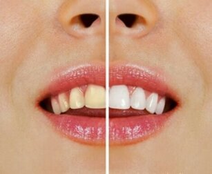 Prodotti per sbiancare i denti naturalmente