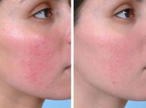 Couperose o rosacea