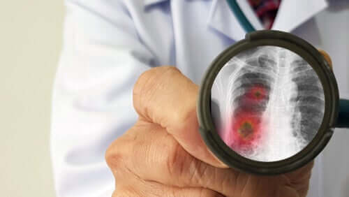 Malattia polmonare, medico e lente di ingrandimento