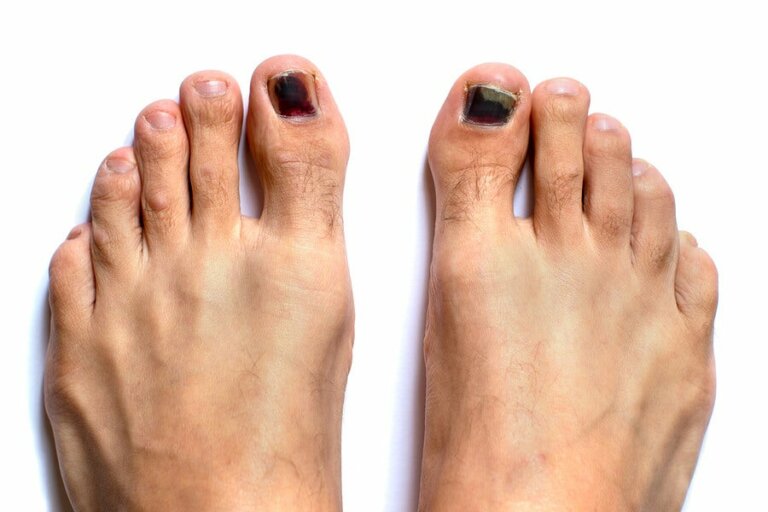 Unghie nere dei piedi: come trattarle?