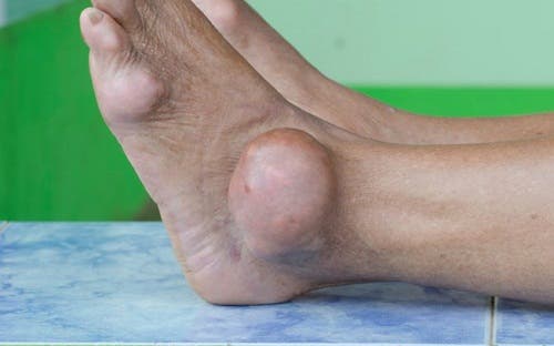 Accumulo di acido urico nel piede