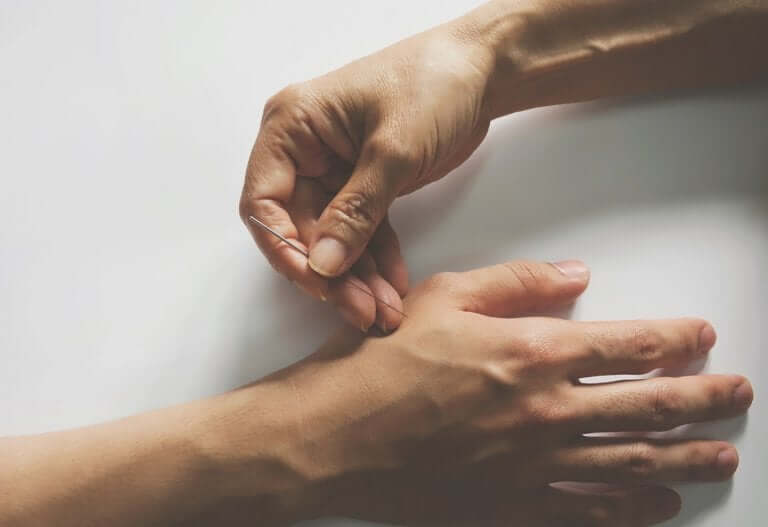 Agopuntura per ridurre il dolore neuropatico