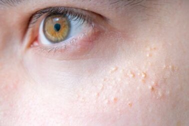 Trattare la cheratosi pilare con rimedi naturali?