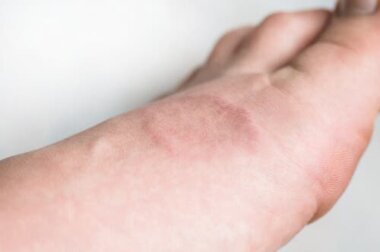 Granuloma anulare: di cosa si tratta?