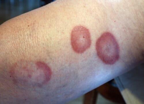 Granuloma anulare sul braccio